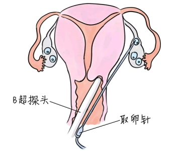 小儿退烧推拿手法 5种乌鲁木齐捐卵宝宝退烧按摩方法